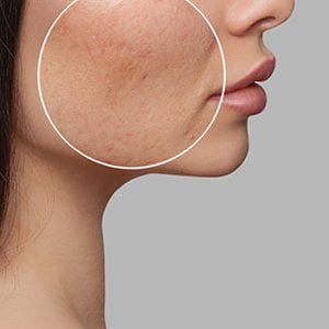 close up of acne scars on woman's face
